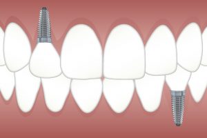 Implante dental en Valladolid