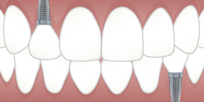 Implante dental en Valladolid