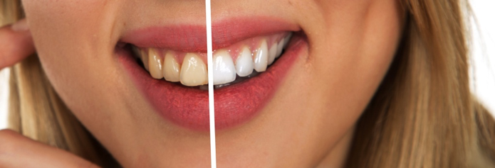 blanqueamiento dental comparativa